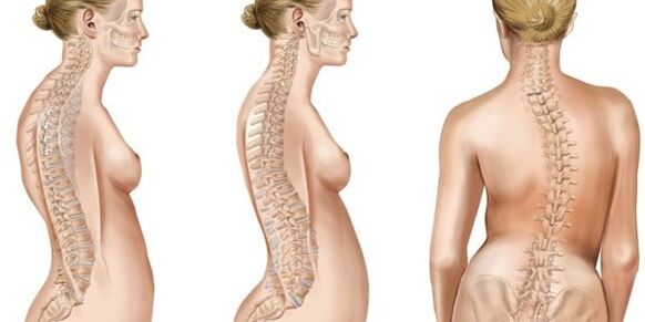 Μείγμα skoliosis των μεσοσπονδύλων δίσκων